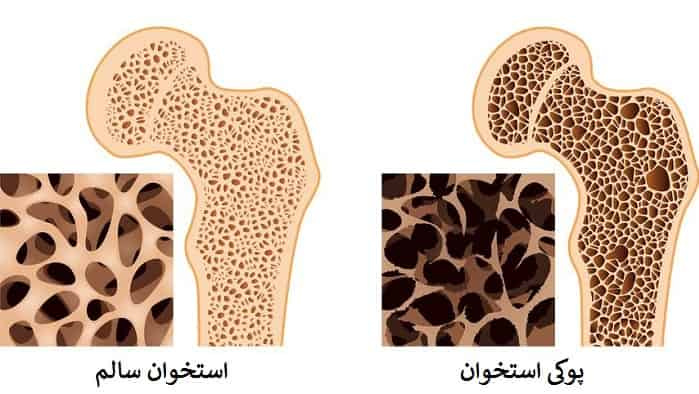 در بیماری پوکی استخوان دقیقا با چه چیزی روبرو هستیم .